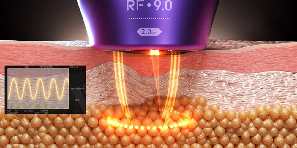 14D hifu machine